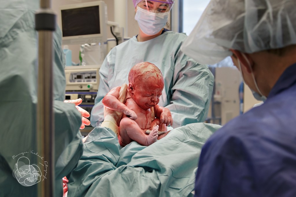 mac Moedergeassisteerde keizersnede