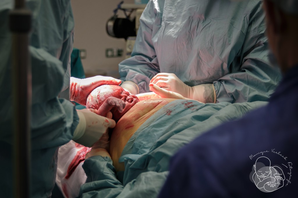 Kindje pakken bij moedergeassisteerde keizersnede