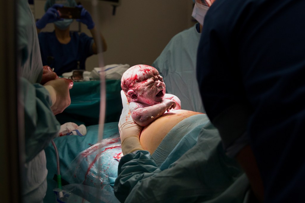 moedergeassisteerde keizersnede mac