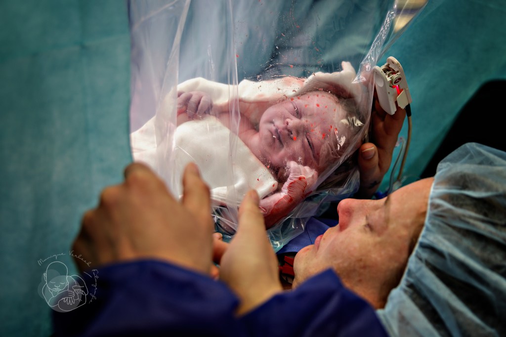 navelstreng doorknippen bij keizersnede