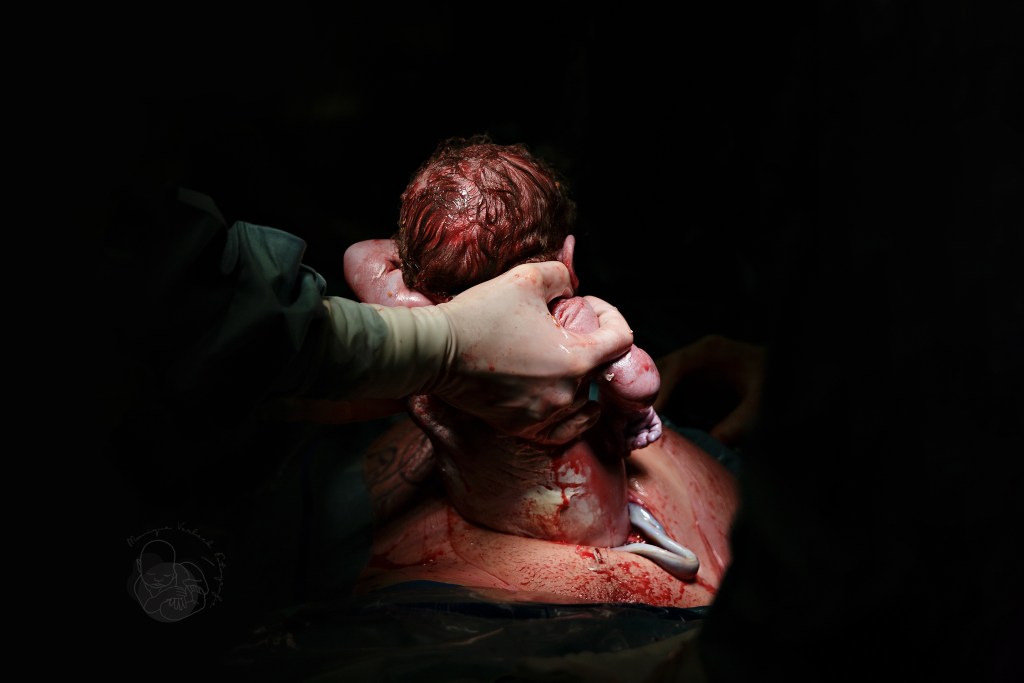 baby wordt uit de buik getild bij een gentle sectio