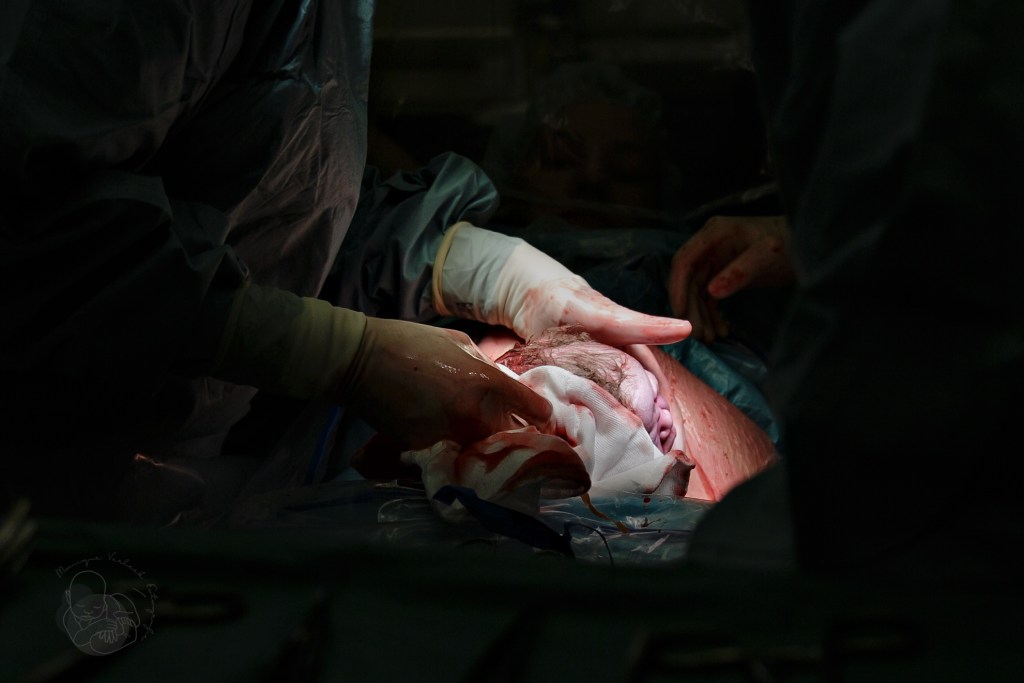 baby's hoofdje geboren tijdens een keizersnede