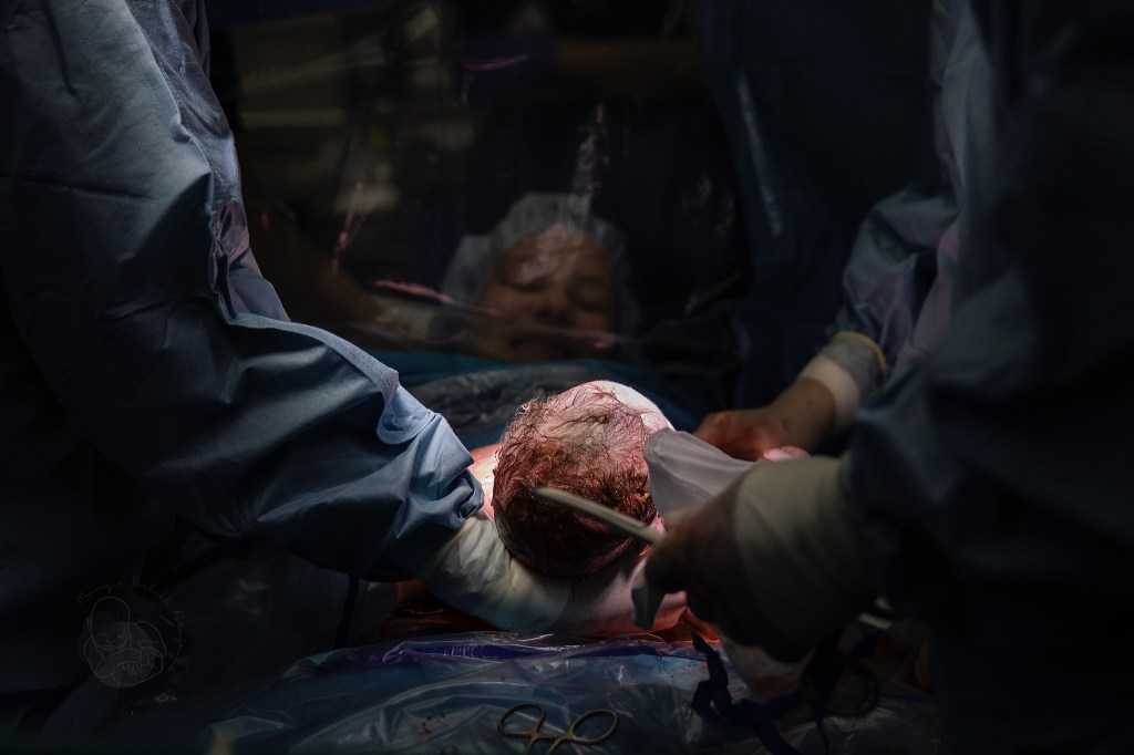 Het plastic luikje waardoor de ouders hun baby geboren zien worden bij een gentle sectio